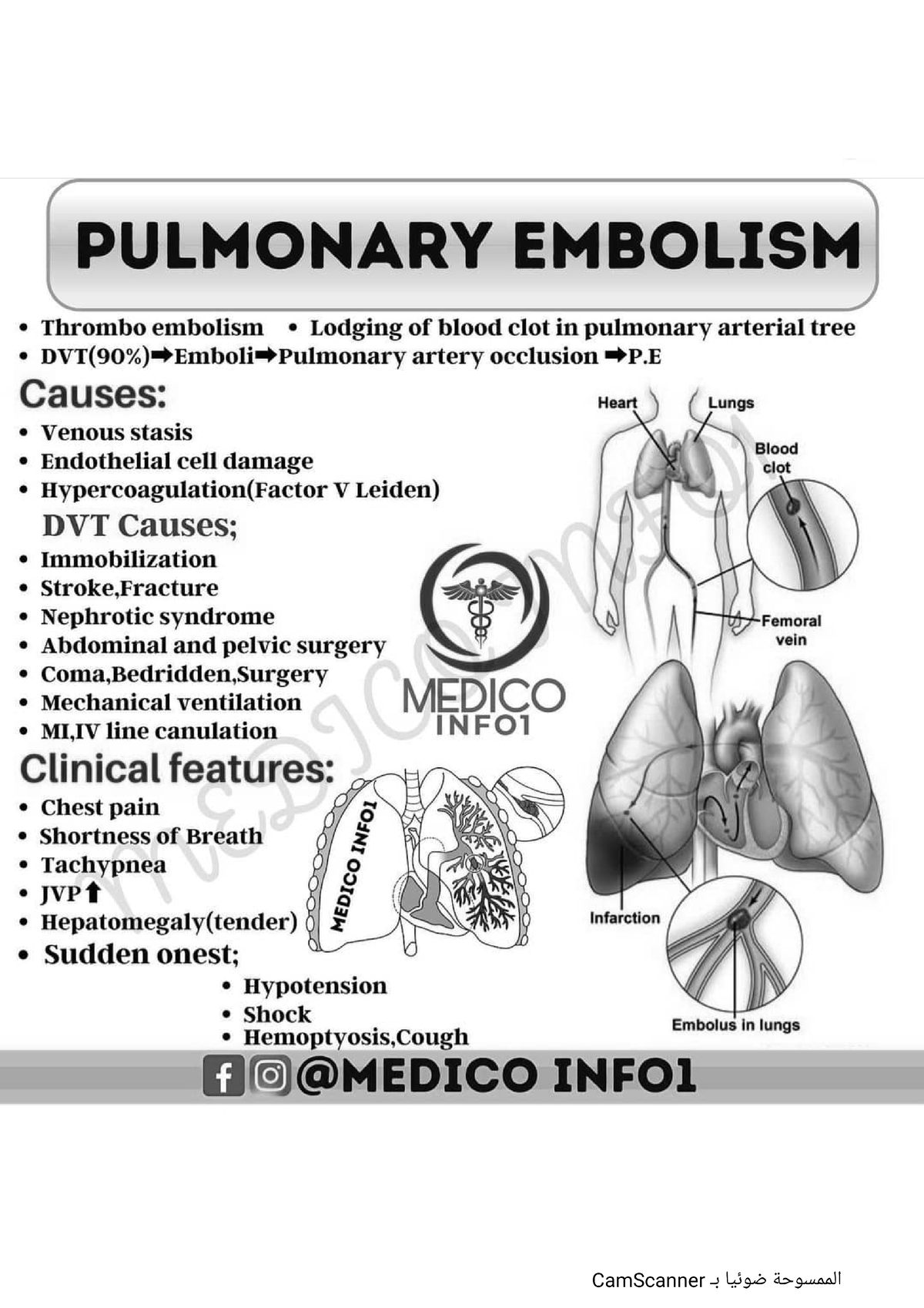 Pulmonary embolism - Course - Medicine - Studocu