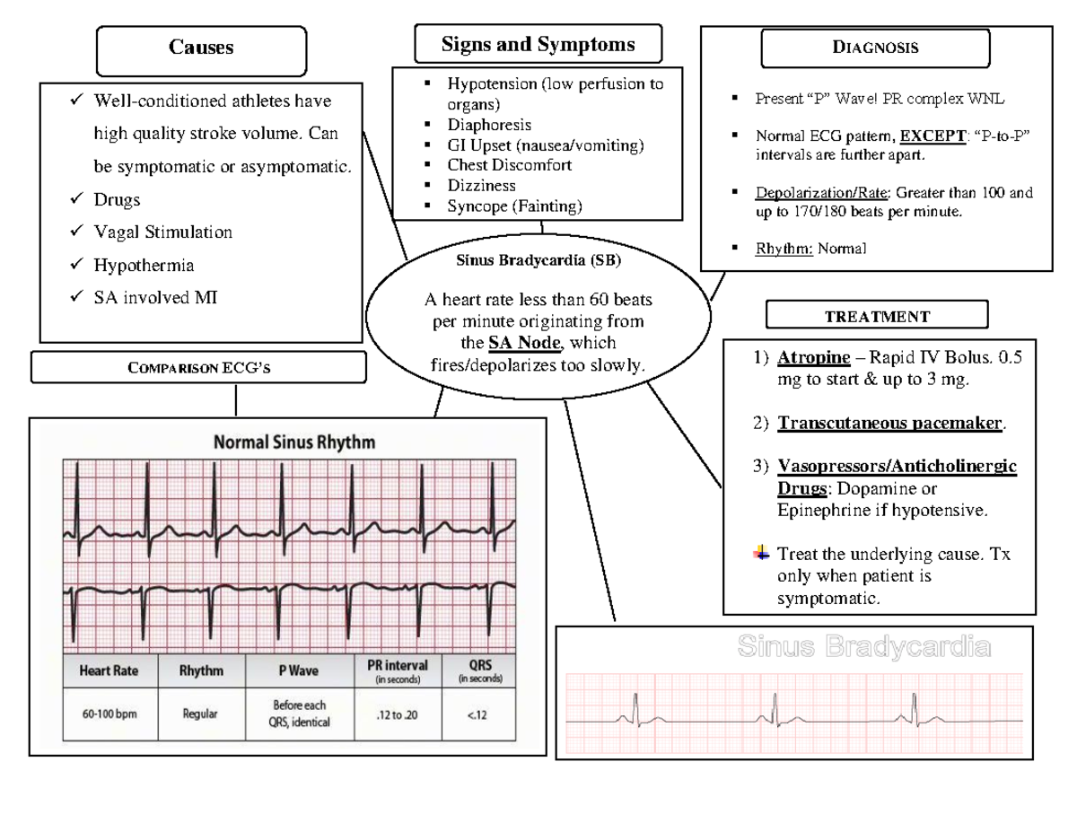 Cardiac Dysrhythmias - Concept Maps - 1 Sinus Bradycardia (SB) A heart ...