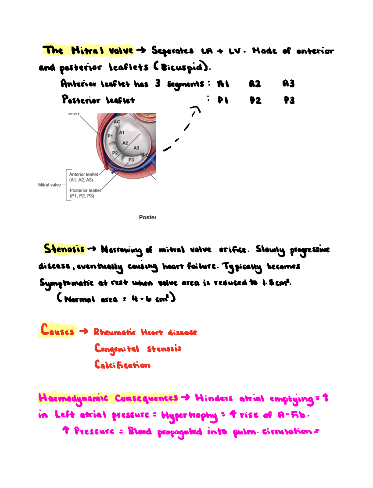 Mitral valve stenosis - The Mitral valve Seperates LA t LV Made of ...