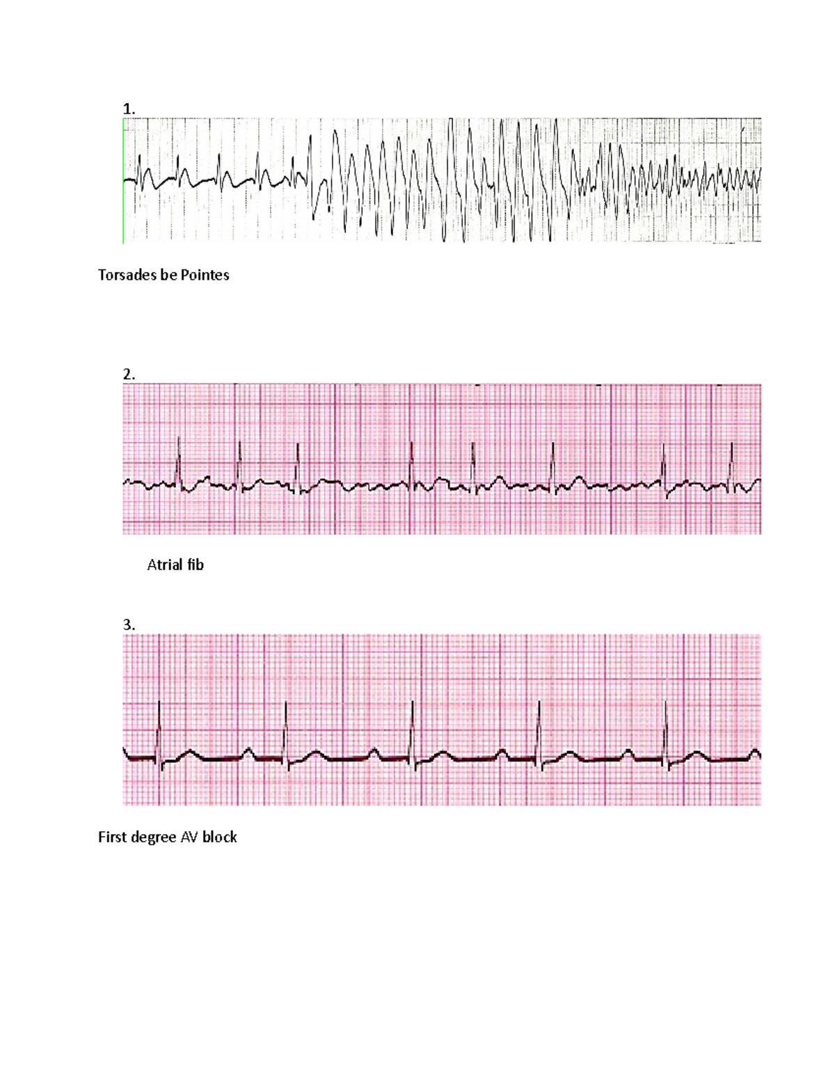 Final exam ECGs - EXP 611 - Torsades be Pointes Atrial fib 3. First ...