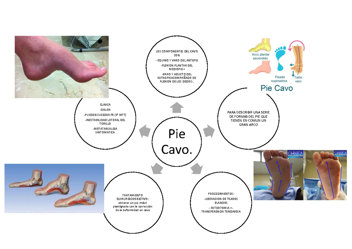 Mapas Mentaales de Ortopedia, Pie Plano. Pie Cavo. LOS COMPONENTES DEL CAVO SON EQUINO Y