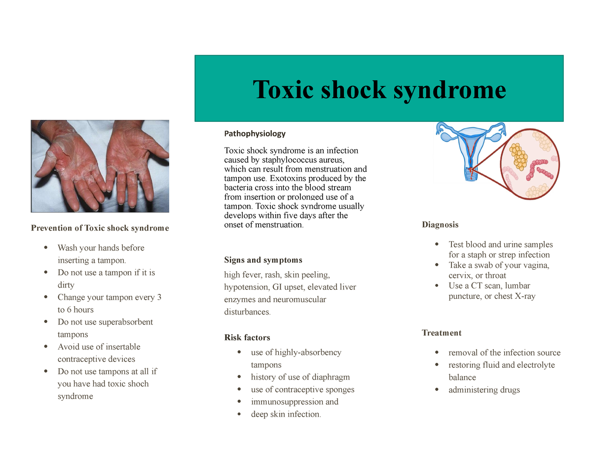 Toxic shock syndrome, Sings Causes Cure