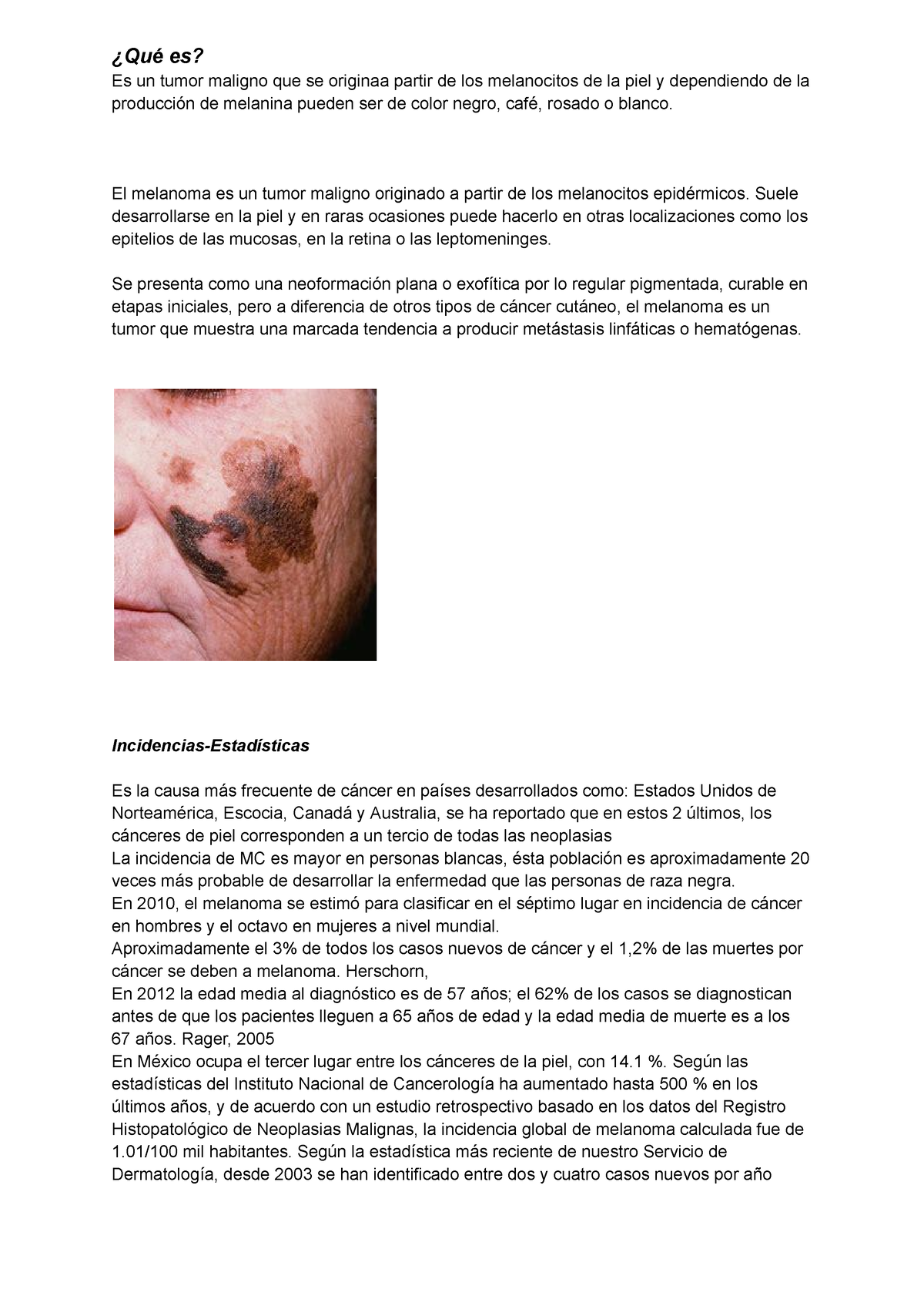 Melanoma Maligno - ¿Qué Es? Es Un Tumor Maligno Que Se Originaa Partir ...