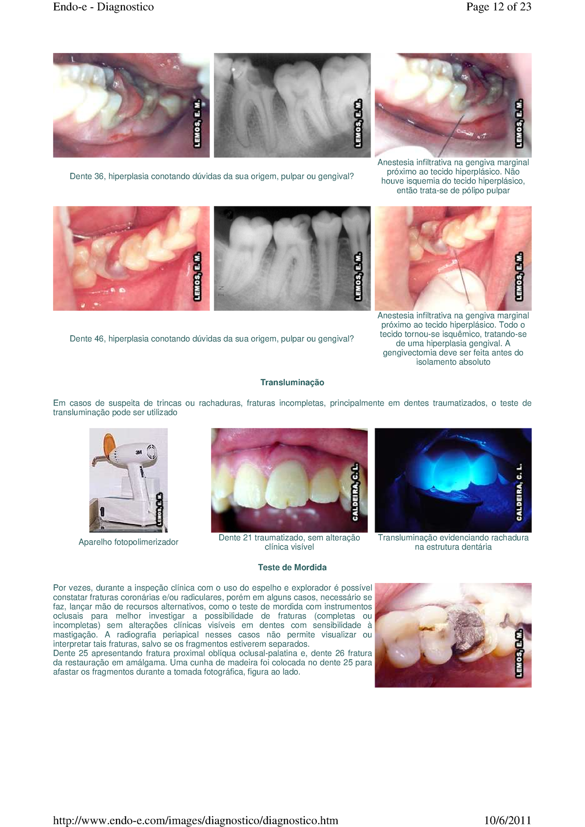 Diagnostico Endo-e - Resumo Endodontia - Dente 36, Hiperplasia ...