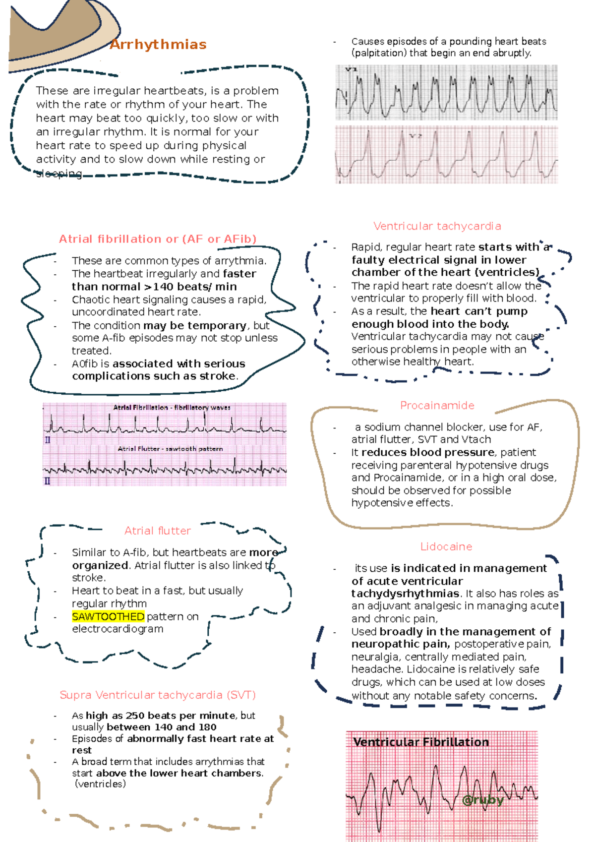 Arrhythmias.docx MS - Arrhythmias - Arrhythmias These are irregular ...