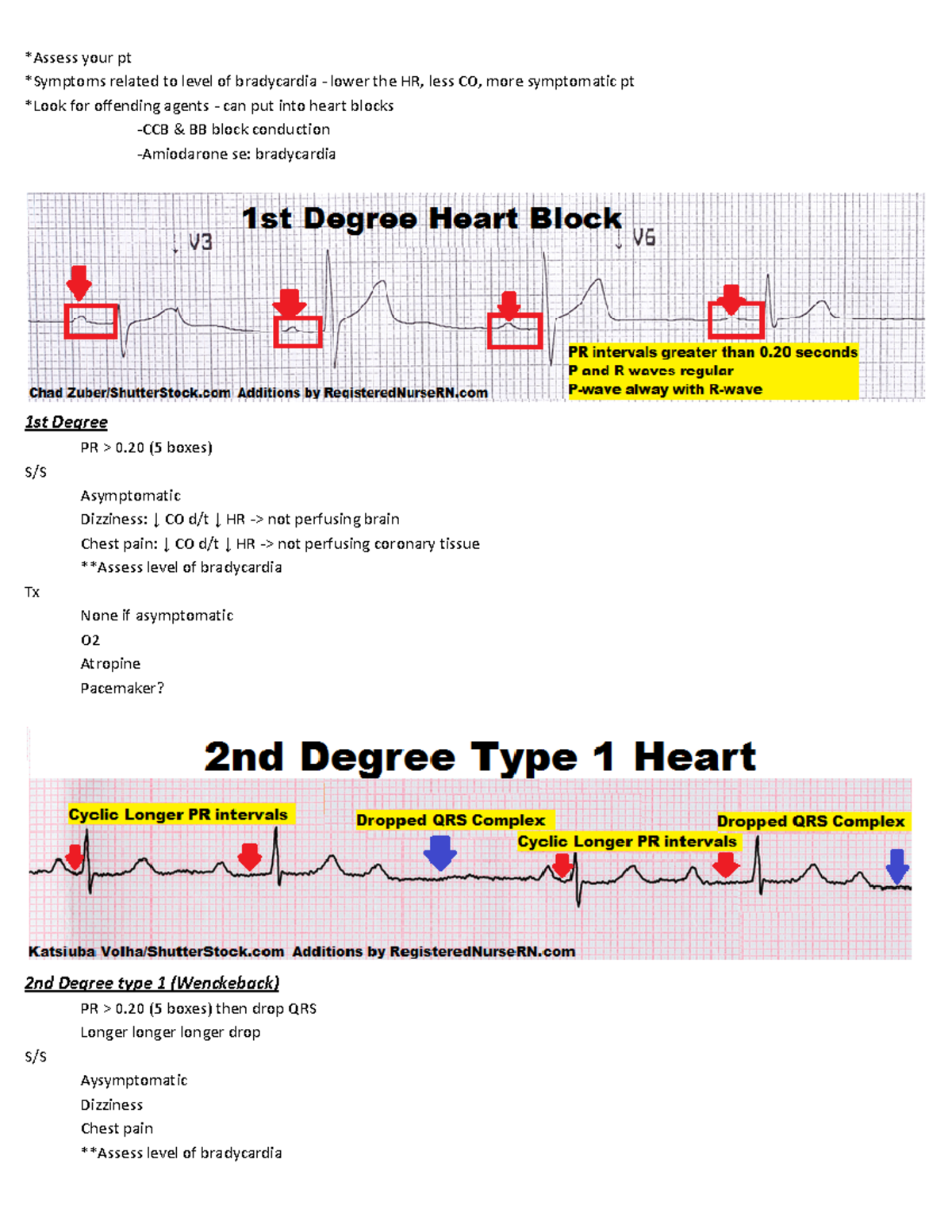 Conduction Abnormalities - *Assess your pt *Symptoms related to level ...