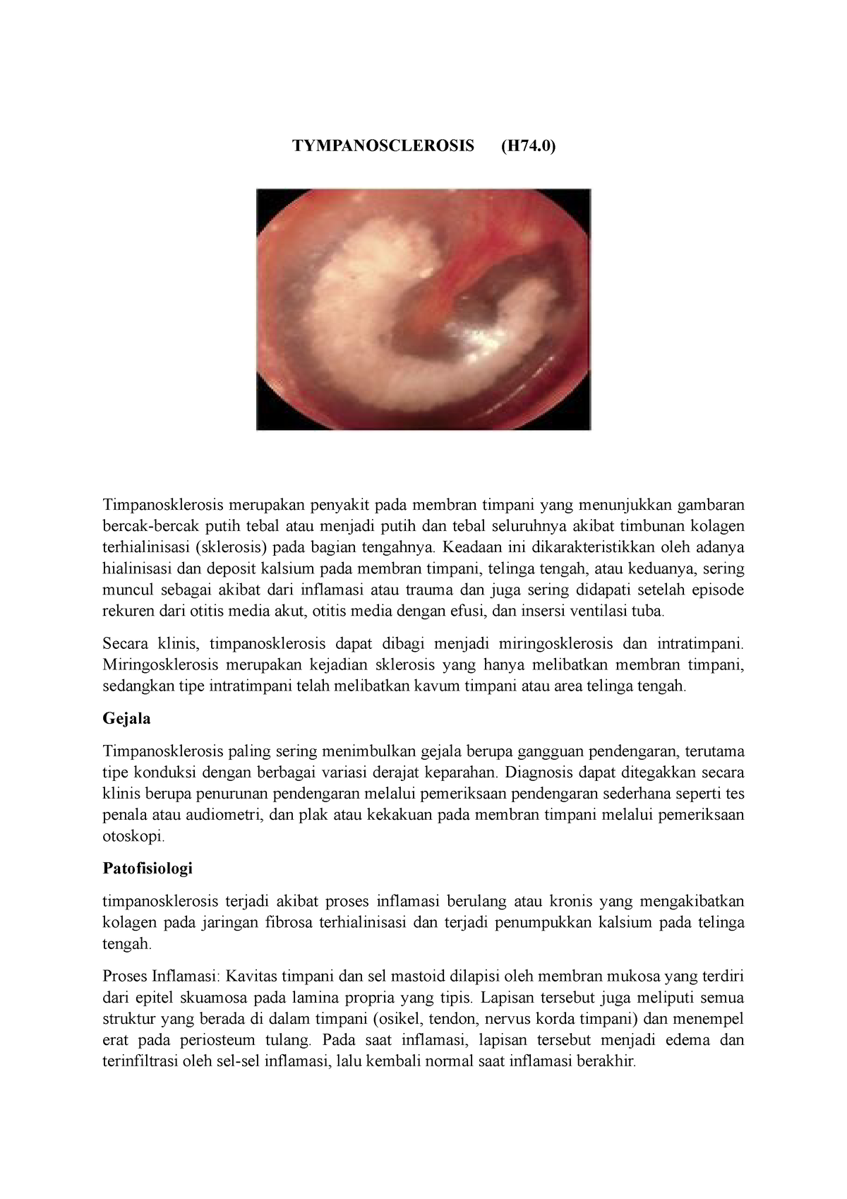 Tympanosklerosis Tympanosclerosis H74 Timpanosklerosis Merupakan