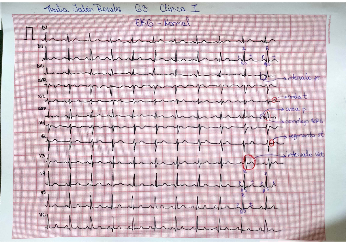 EKG normal, BRD, BRI y fibrilación auricular - Clinica I - Studocu