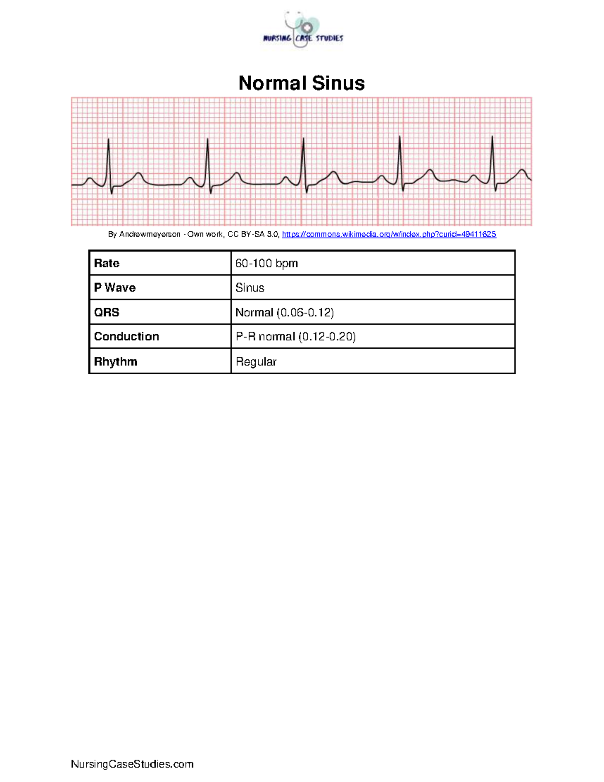 ECG- Cardiac-Lesson-for Term 4 - Normal Sinus By Andrewmeyerson - Own ...