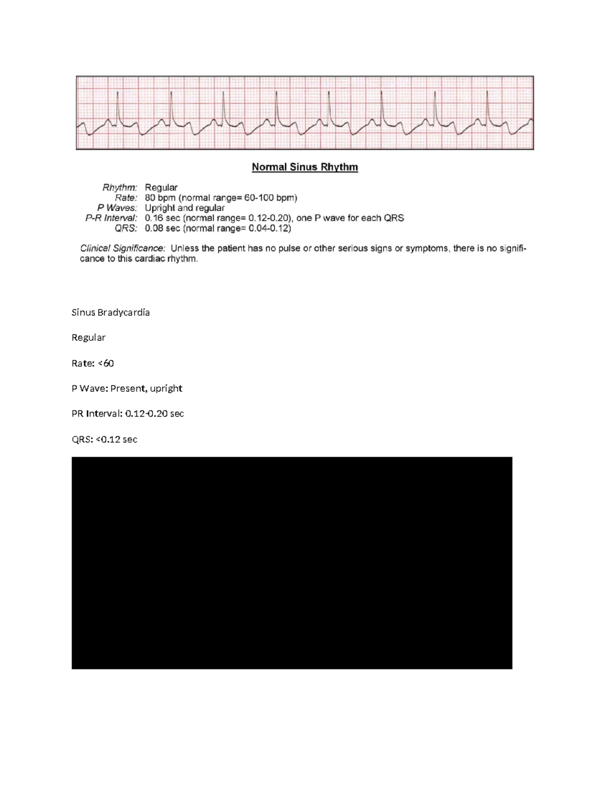 Relias Dysrhythmia Basic TEST Answers 2024-2025 Dysrhythmia – Basic A ...