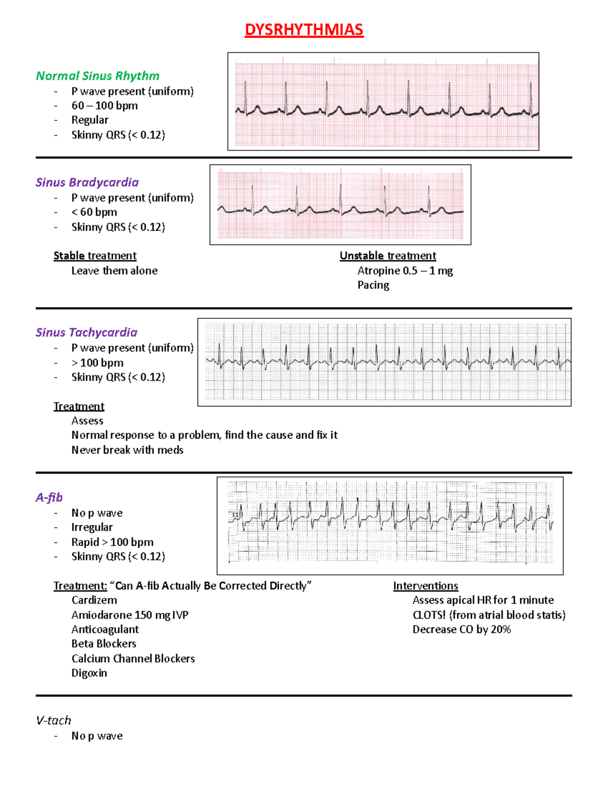 My Dysrhythmias study guide - DYSRHYTHMIAS Normal Sinus Rhythm P wave ...