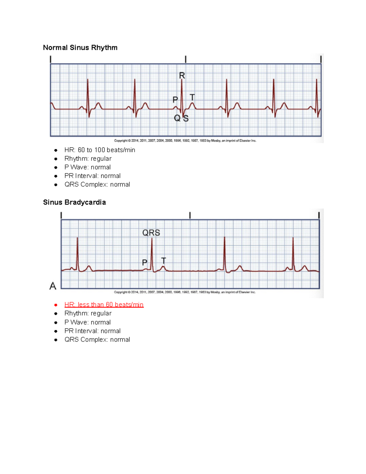 Differing EKG Strips - Dr. Shannon Dusack, BSN, RN, CNP - Critical Care ...