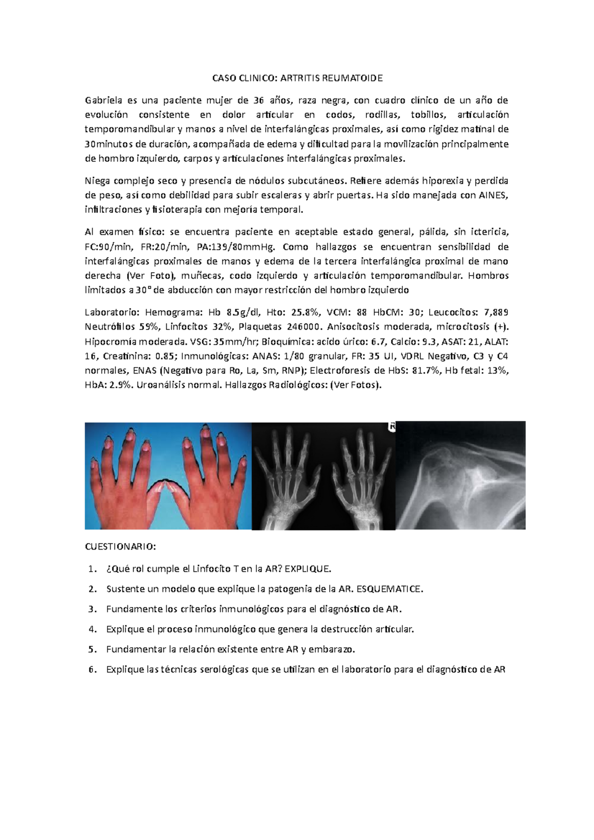 CASO Clinico Artritis reuma CASO CLINICO ARTRITIS REUMATOIDE Gabriela es una paciente mujer