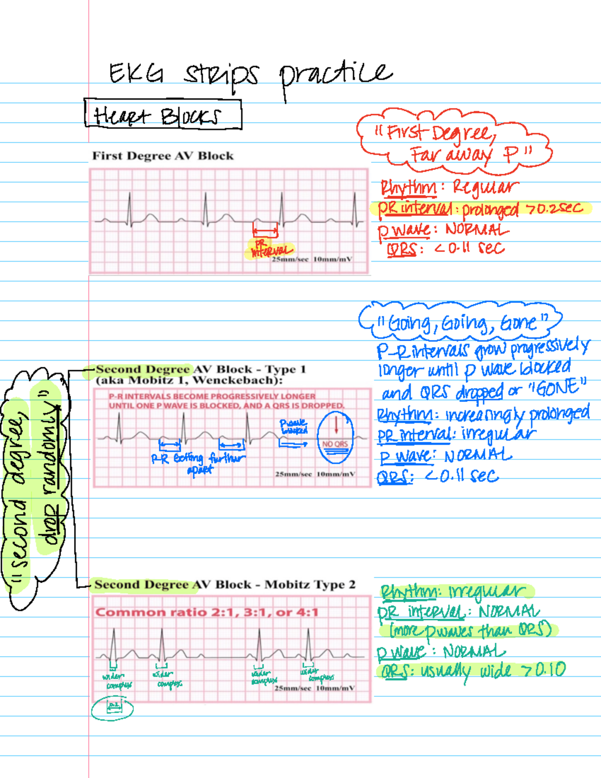 Remembering AV Blocks - EKG strips practice Heartblookt HFirstDegregy ...