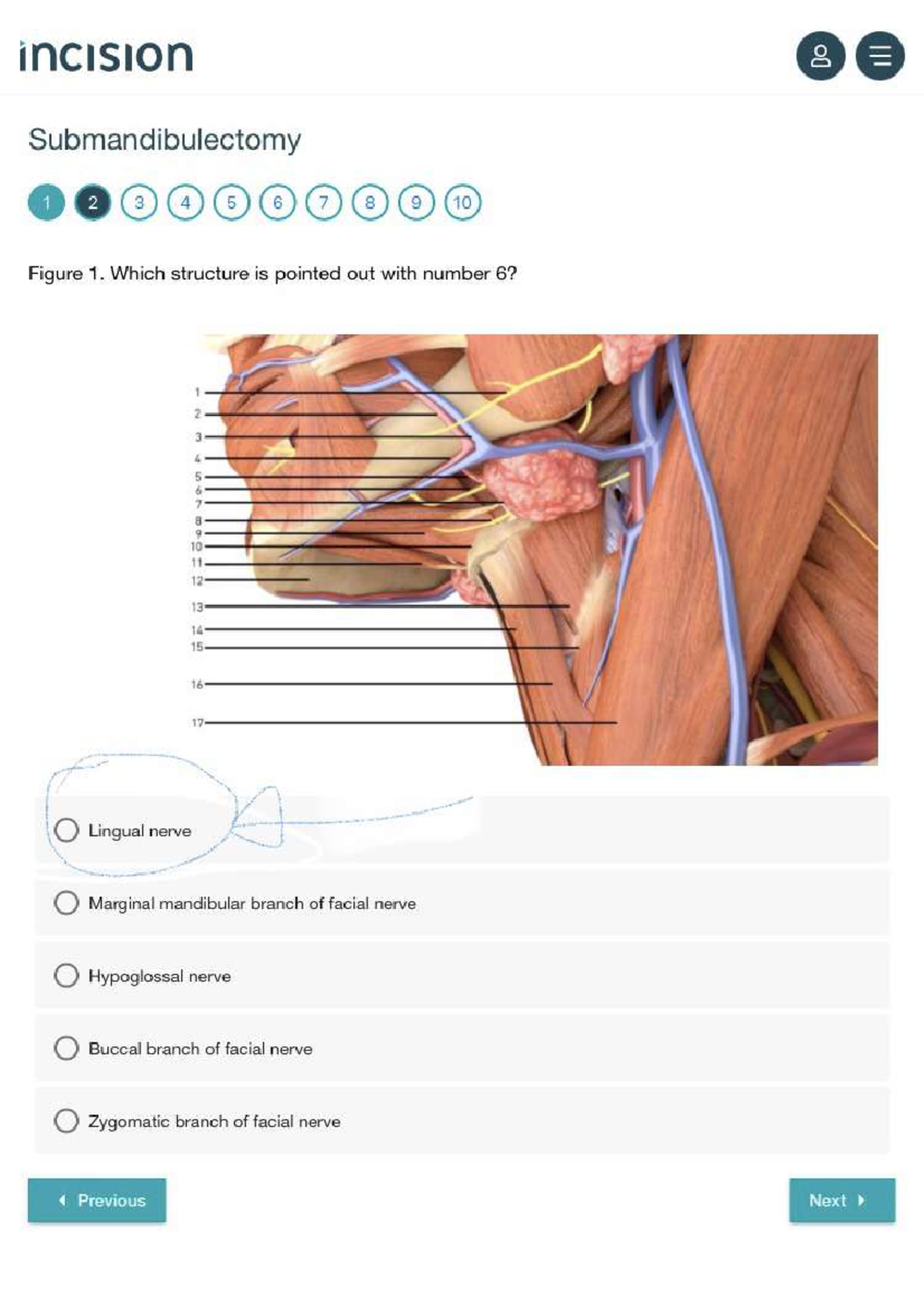 Submandibulectomy 1 Internal Medicine Studocu