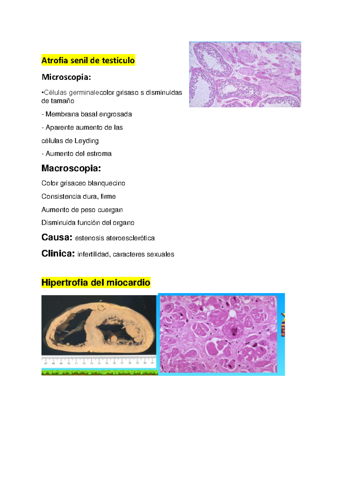 Repaso patologica lab 1 - Atrofia senil de testiculo Microscopia ...