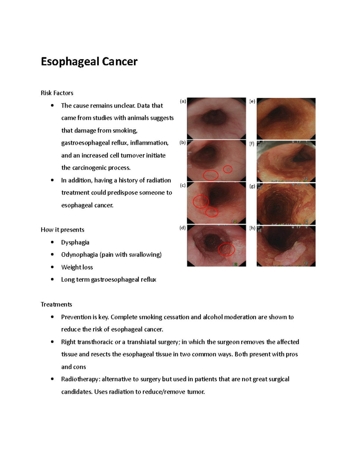 Esophageal Cancer - Esophageal Cancer Risk Factors The cause remains ...