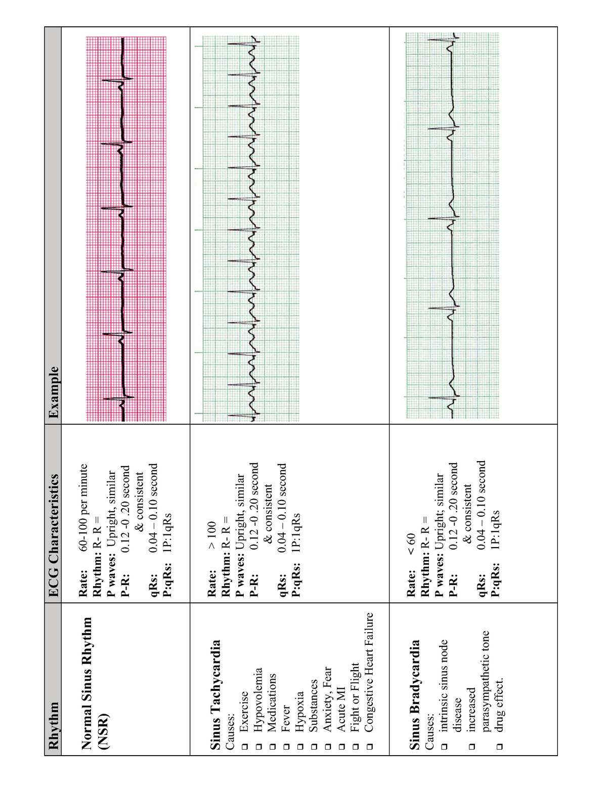 EKG Flash Cards - Rhythm ECG Characteristics Example Normal Sinus ...