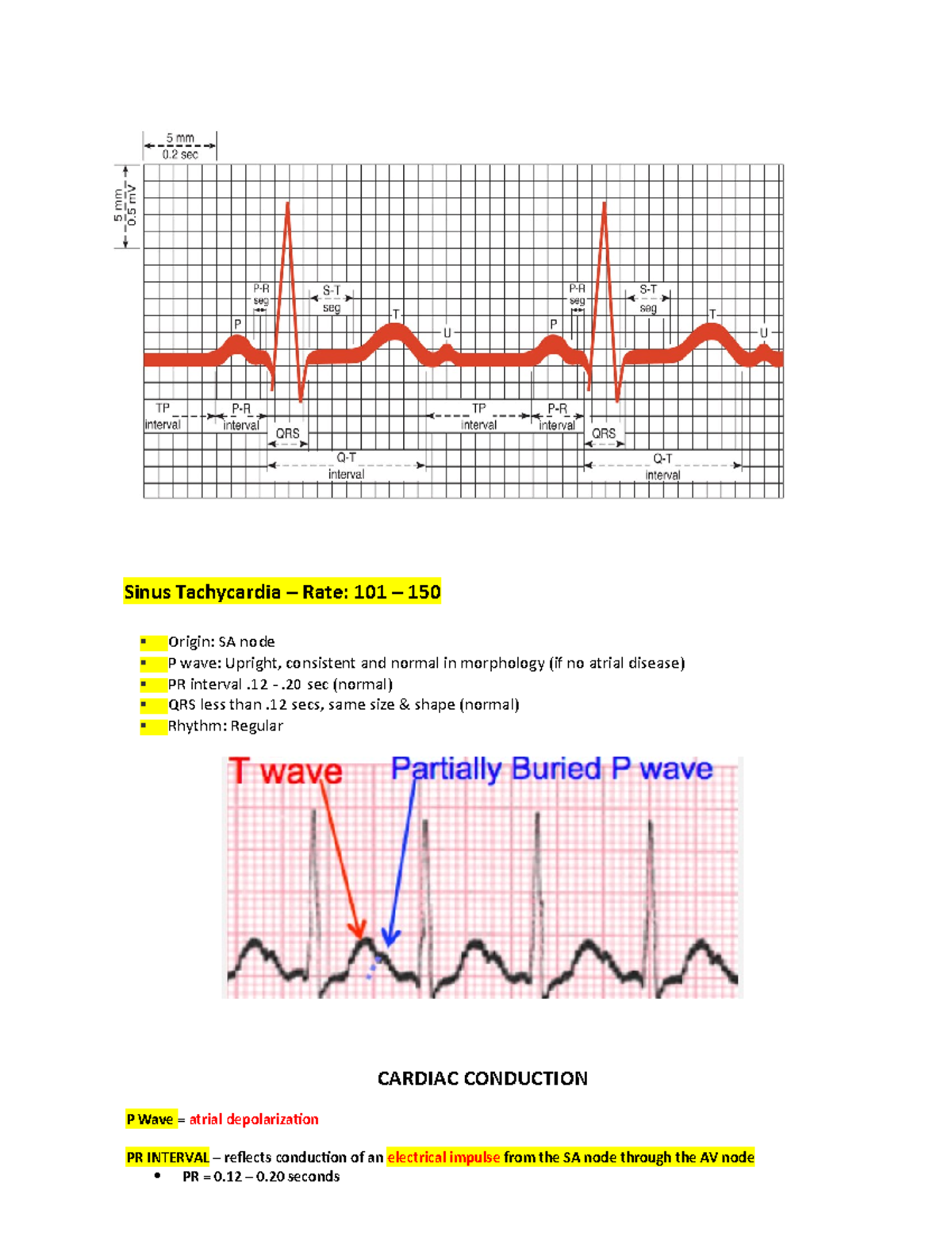 Sinus Rhythms - Exam Study Material - Sinus Tachycardia – Rate: 101 ...