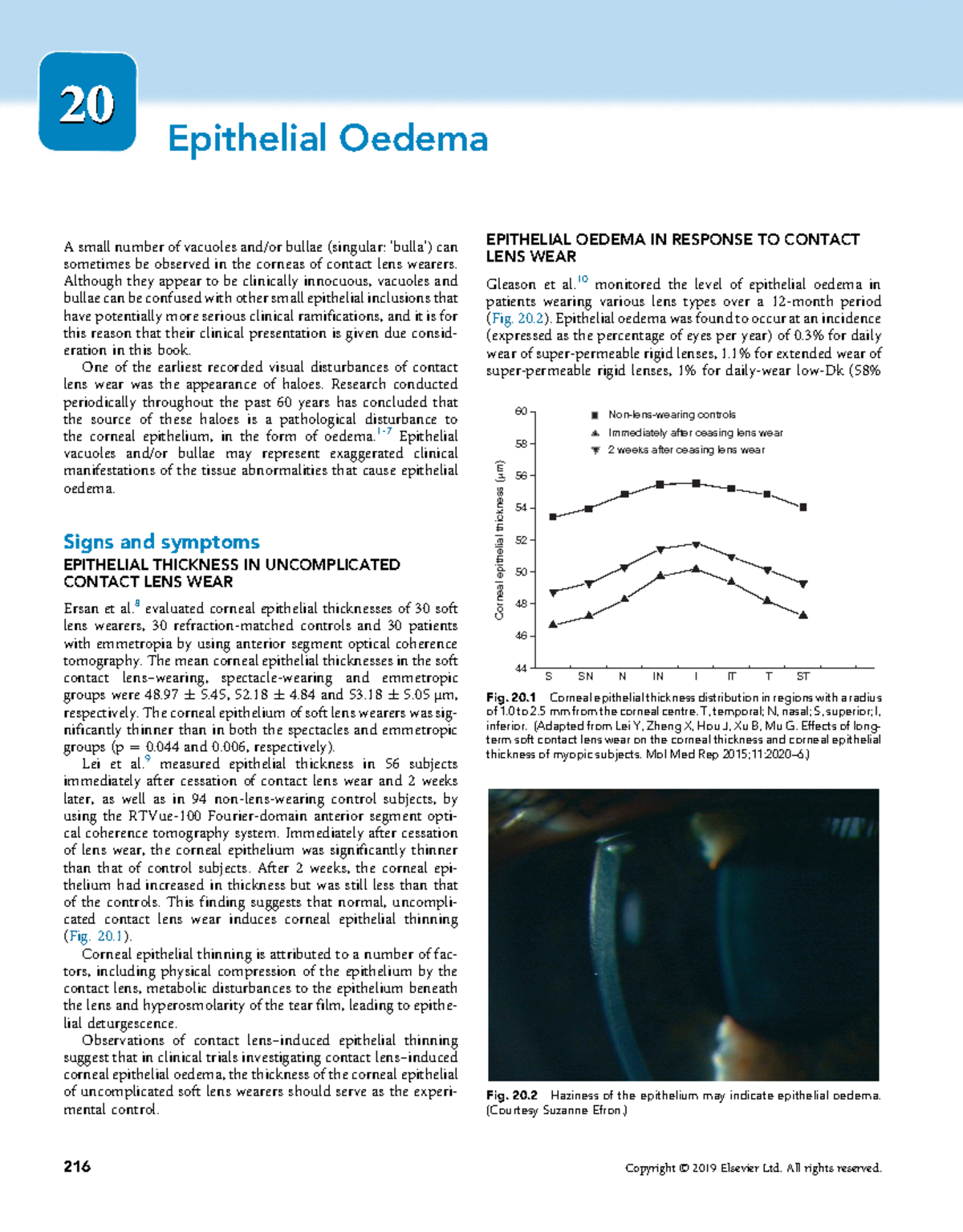 Epithelial Oedema Contact Lens Complications 2020 Epithelial Oedema A