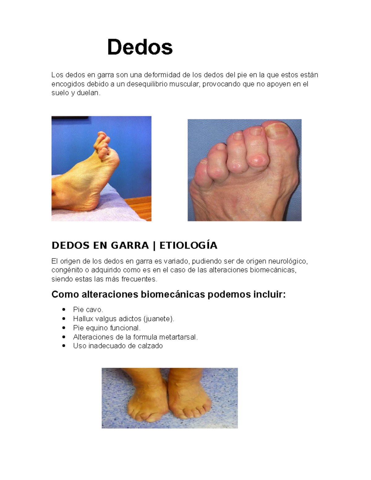 Informe patologias del pie Los dedos en garra son una deformidad de