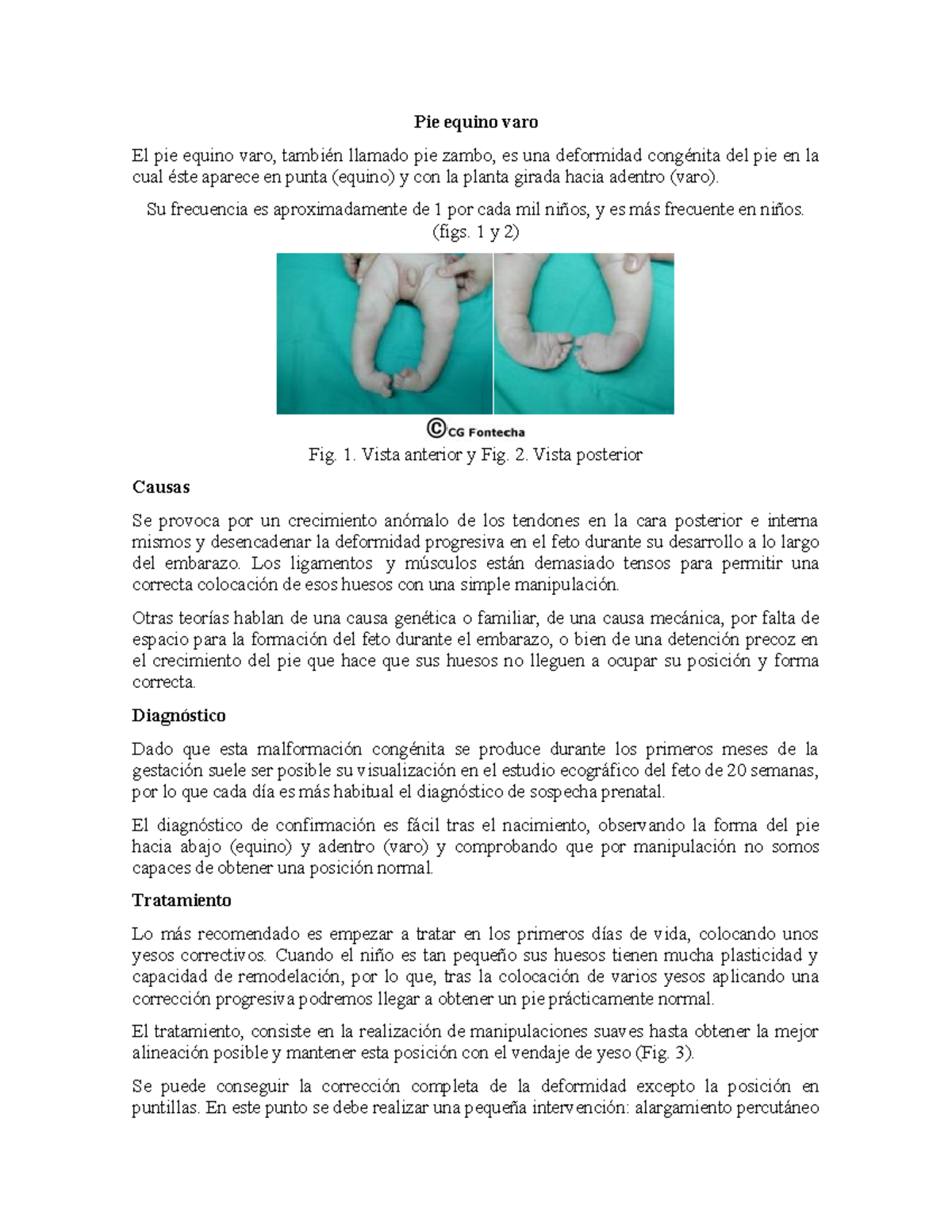 Embriodoc Embriología Pie equino varo El pie equino varo, también