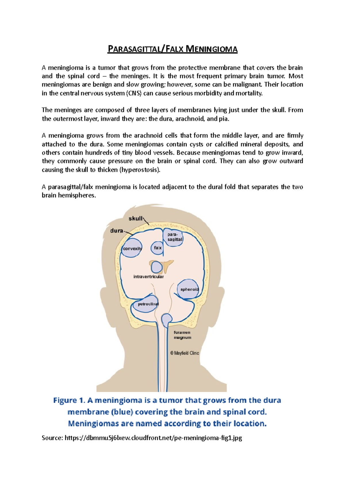 Parasagittal Meningioma