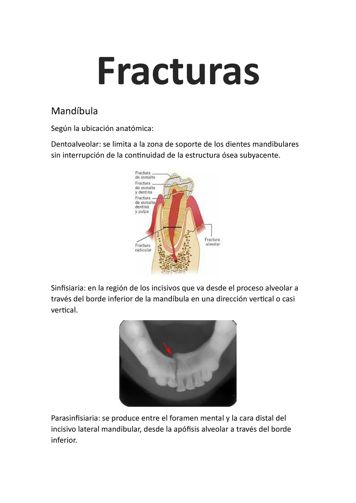 clasificación de fractura de mandíbula