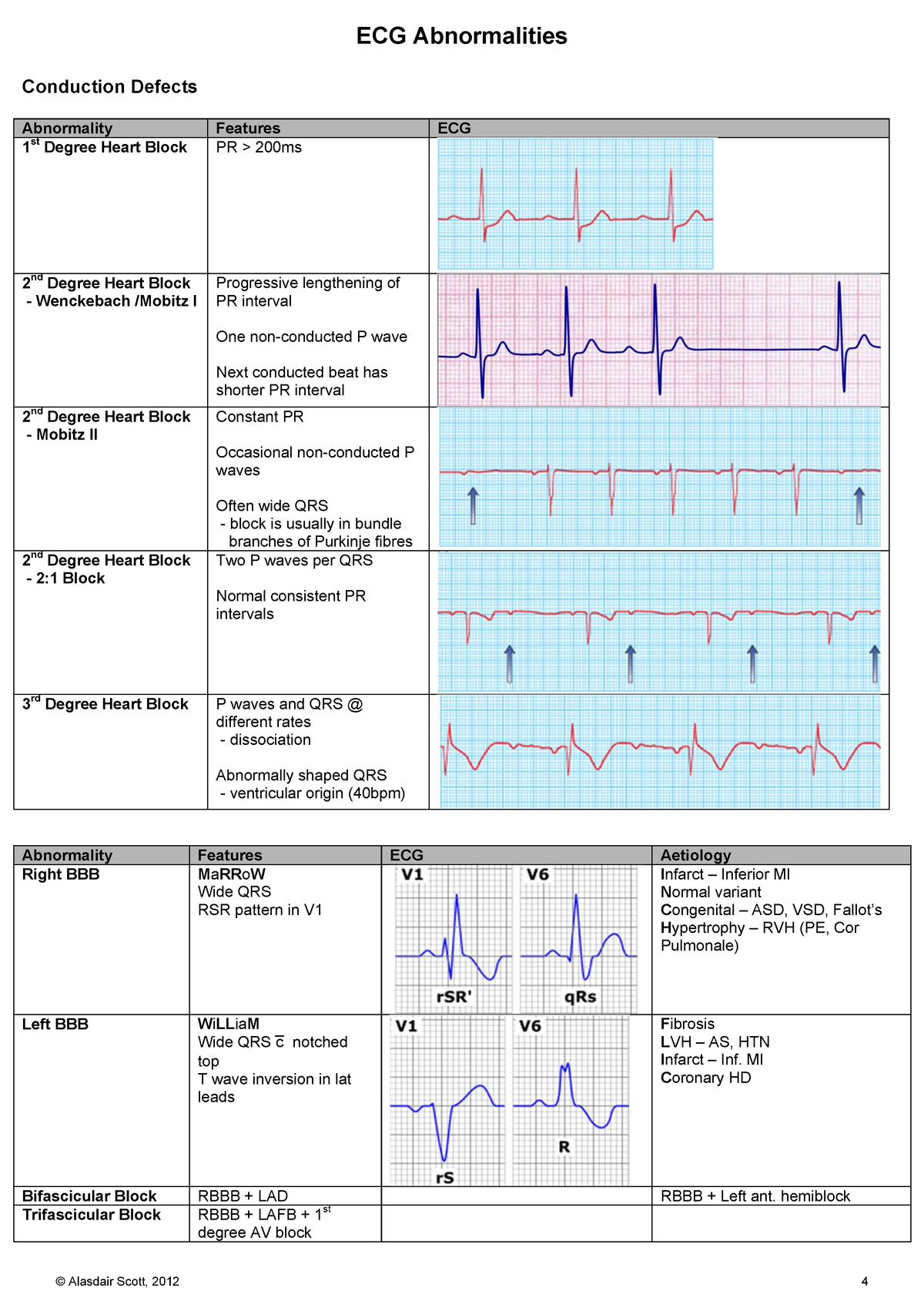 ECGs for cardiac abnormalities - ECG Abnormalities Conduction Defects ...