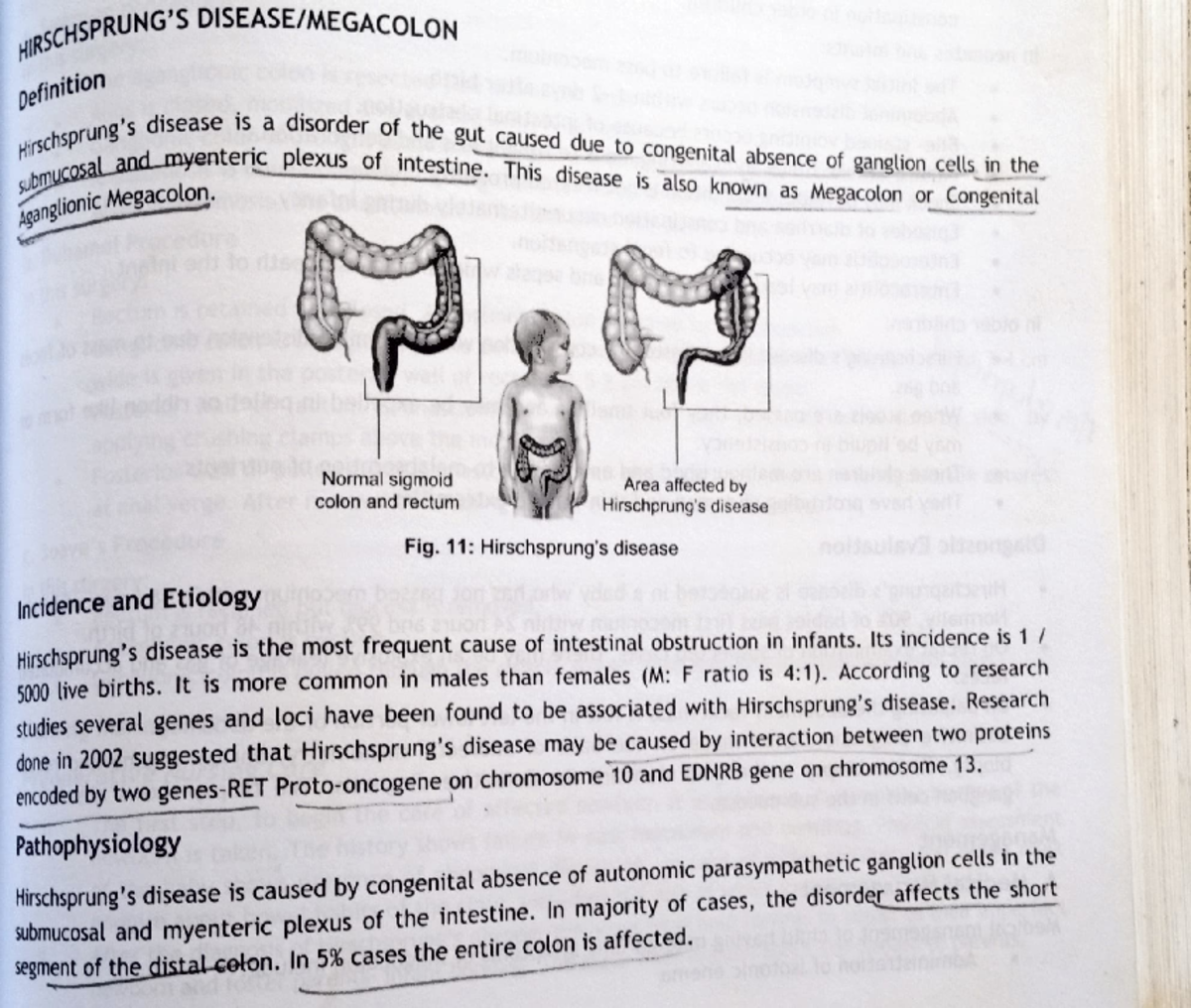 Hirschsprung'S Disease - HIRSCHSPRU AcCHSPRUNG's DISEASE/MEGACOLON ...