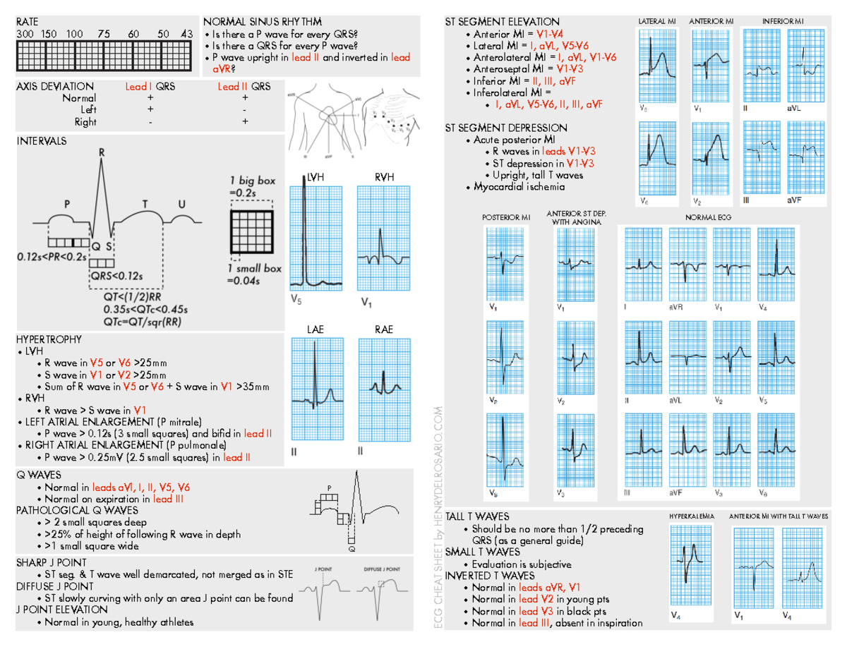 Ecgcheatsheet 23 - Ecg - HYPERTROPHY • LVH R wave in V5 or V6 >25mm S ...