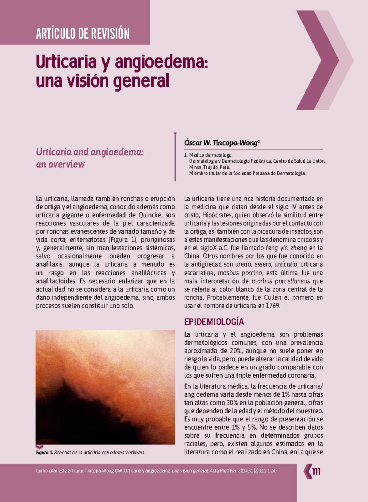 Urtic y angioed - deta - Urticaria y angioedema: una visión general ...