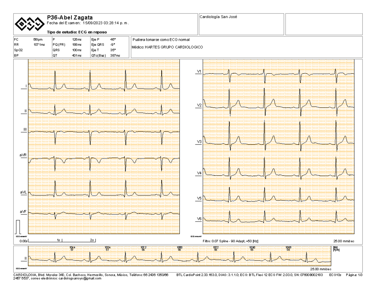 Onda R en V1 (V2) - Diagnostico electrocardiografico - 104457 105457 ...