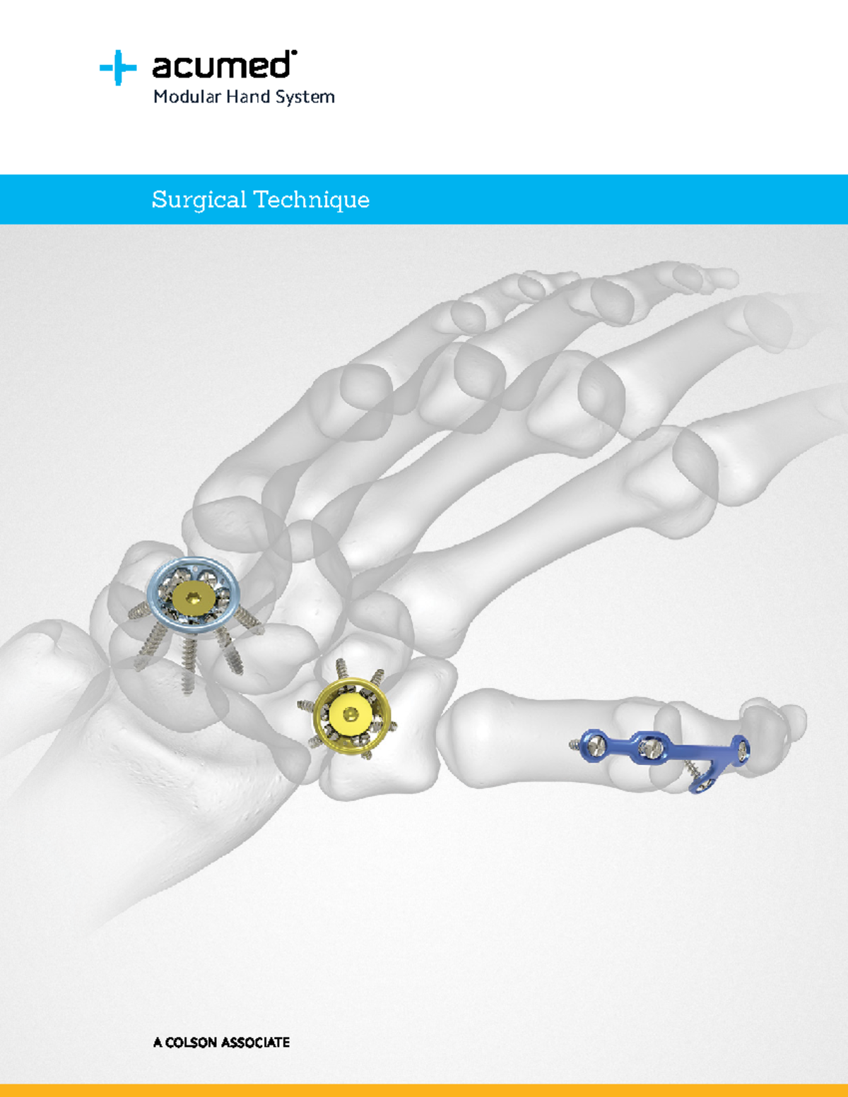 Modular Hand System Surgical Technique - Surgical Technique Modular ...