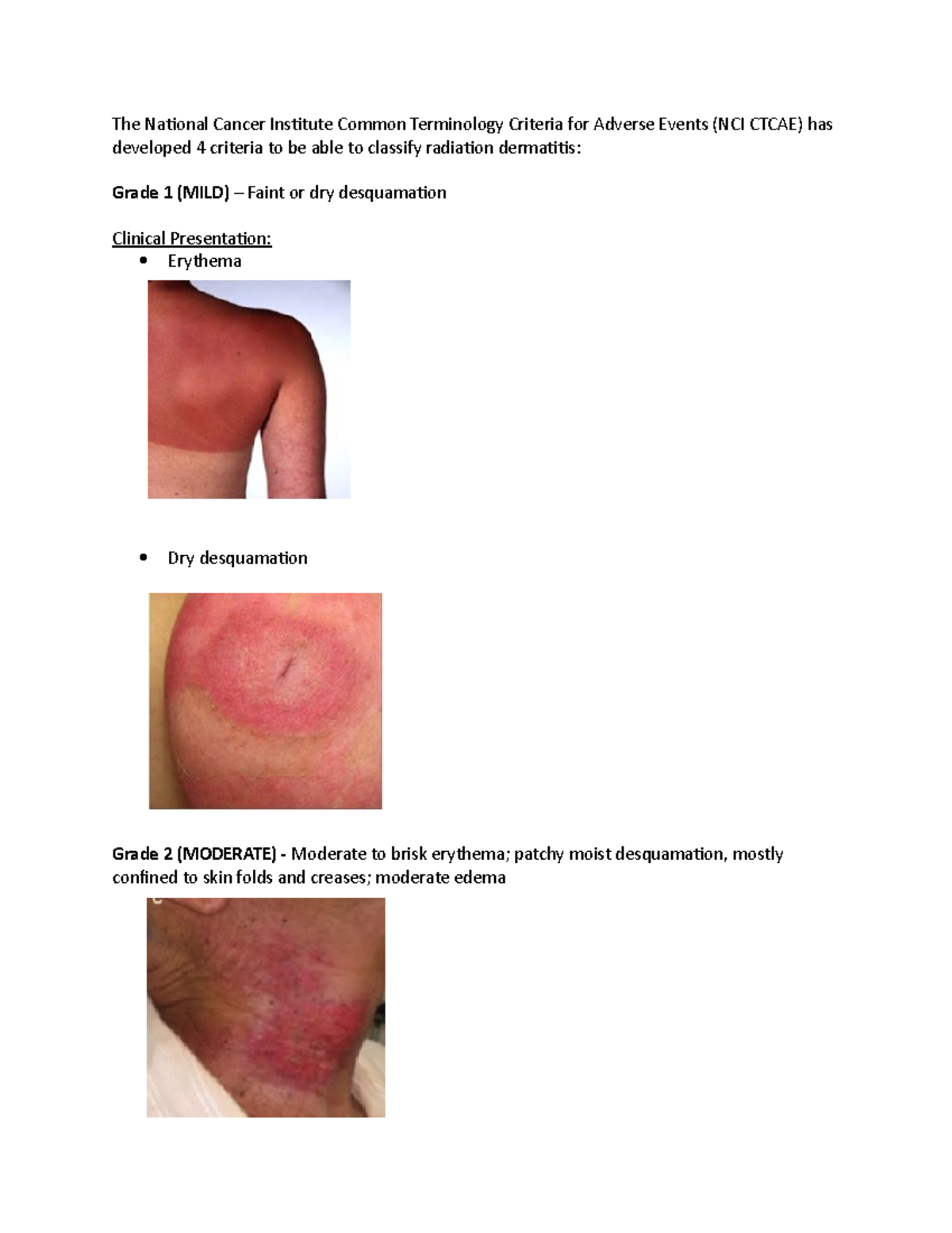 Grading and Management of Radiation Dermatitis The National Cancer Institute Common