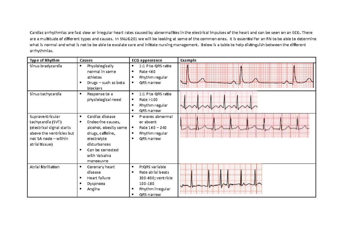 Cardiac Arrhythmias Guide - Cardiac Arrhythmias Are Fast Slow Or ...