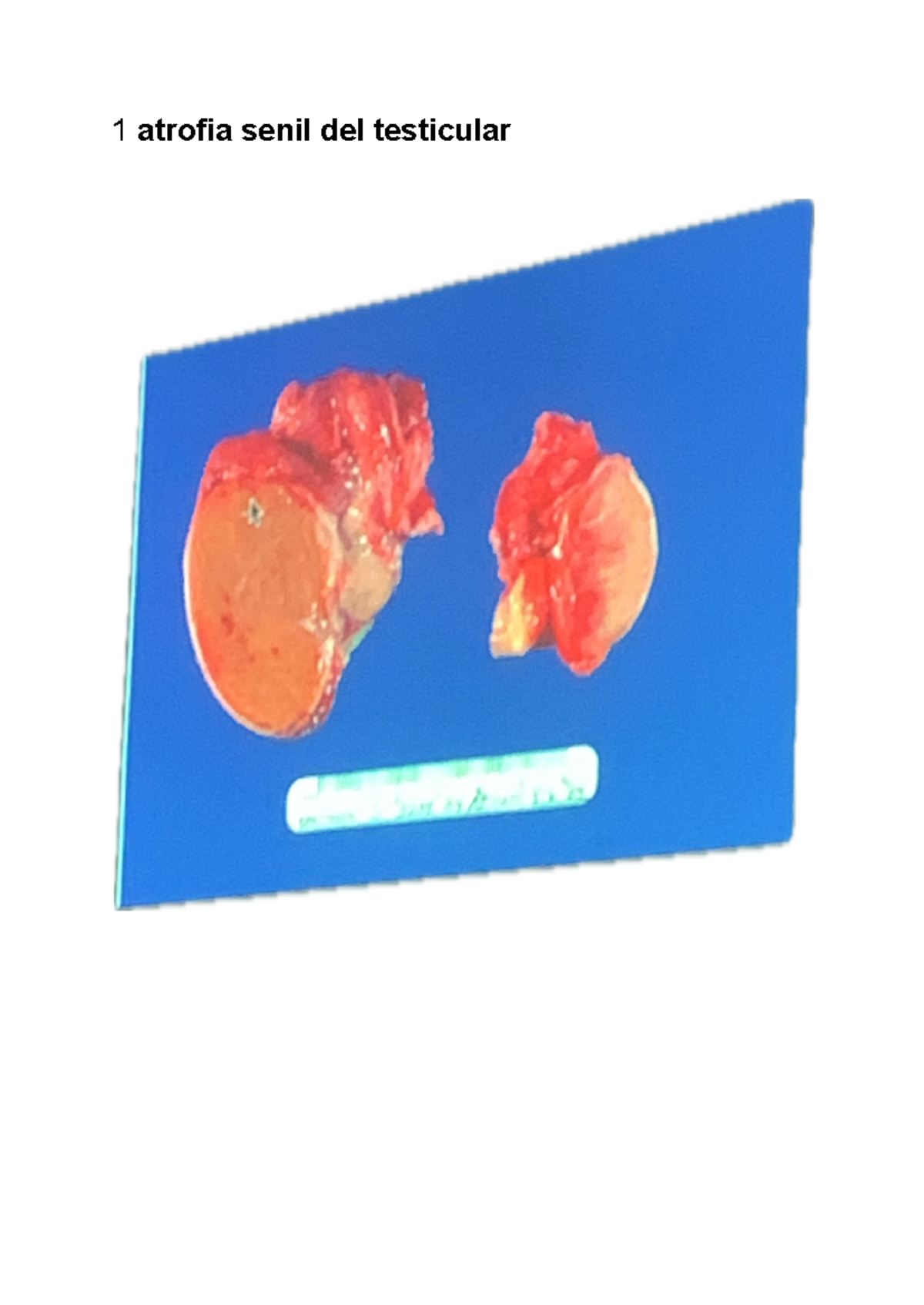 Anatopato - Anatomía Patológica - 1 atrofia senil del testicular ...