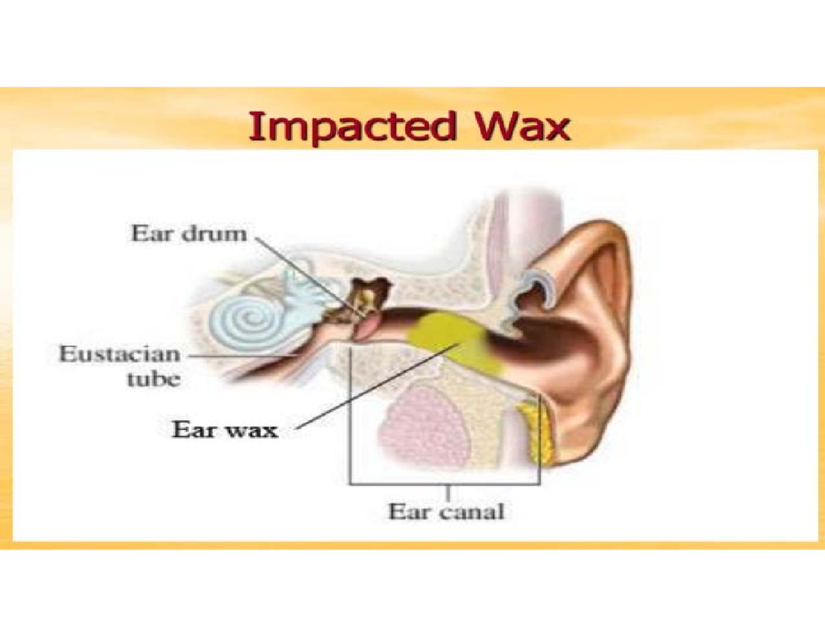 Impacted WAX Medical surgical nursing INTRODUCTION Wax is composed