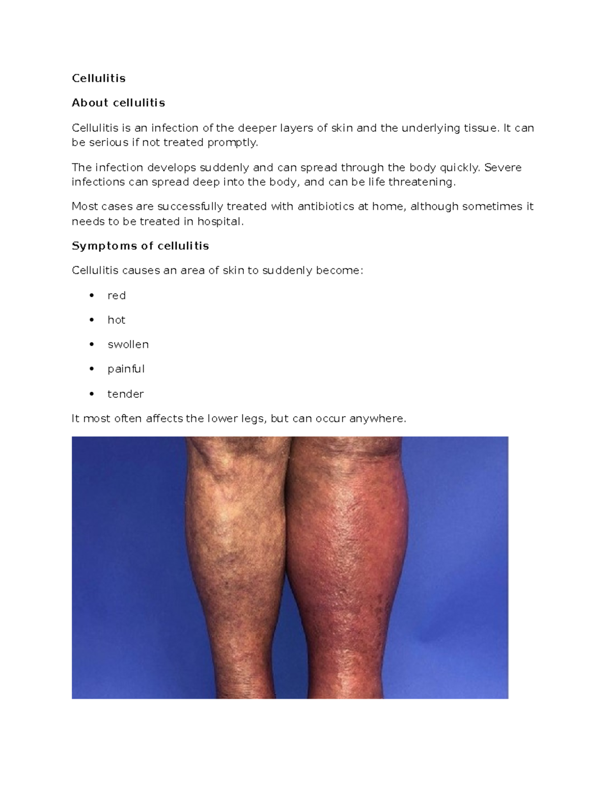 Cellulitis - common illness and conditions - Cellulitis About ...