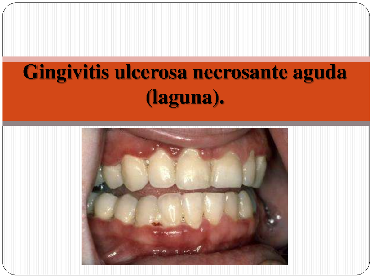 Gingivitis ¿Qué es? La gingivitis consiste en una inflamación de las