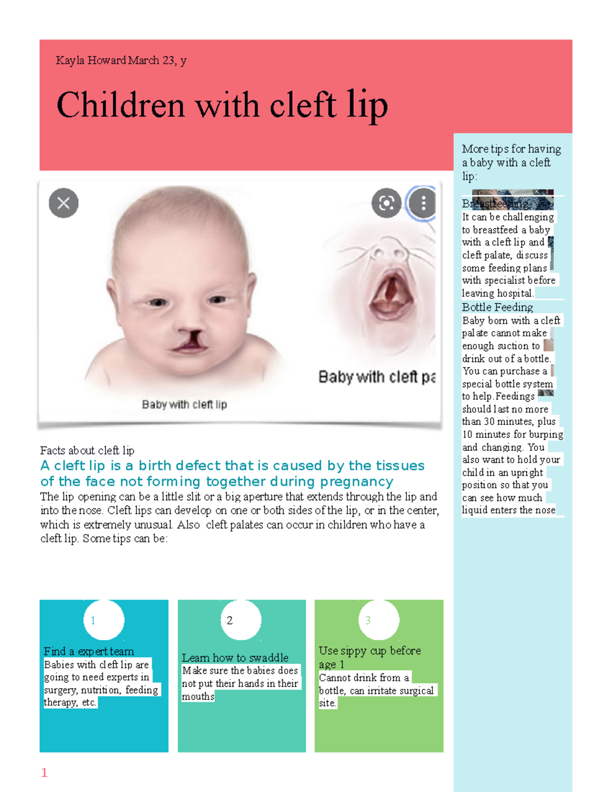 Cleft Lip homework 1 More tips for having a baby with a cleft lip