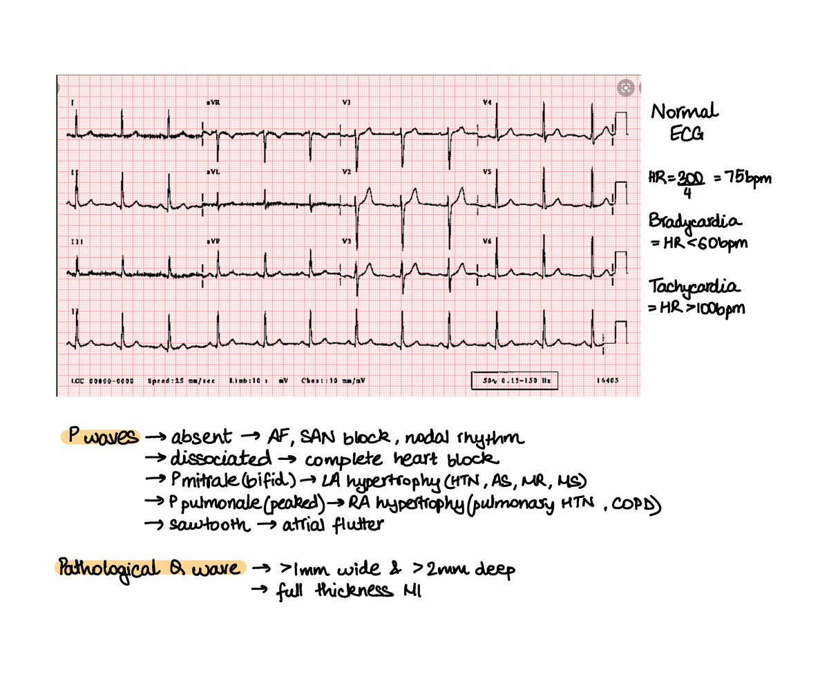 Cardiology Conditions - Arrhythmias, Conduction Defects, ACS, Angina ...